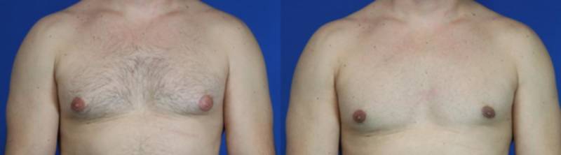 Robert J Paresi Jr, MD - Side view of a 30 year-old male who had excision  of gynecomastia (man boobs) via a periareolar incision at one year  postoperatively. Notice the improvement in