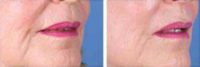 Restylane for nasolabial folds and marionette lines