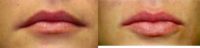 18-24 year old woman treated with Juvederm