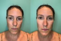 35-44 year old woman treated with Ultherapy and Tear Trough Fillers