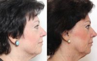 Woman on her 60's treated with Facial Fat Transfer