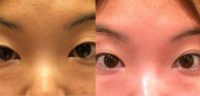 25-34 year old woman treated with Eyelid Retraction Repair