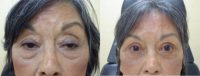 Bilateral Blepharoplasty and Levator Resection Eyelid Surgery