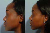 25-34 year old woman treated with African American Rhinoplasty