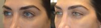 Young Woman Underwent Almond Eye Or Cat Eye Surgery With Natural Results