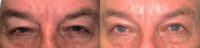 55-64 year old man treated with Ptosis Surgery