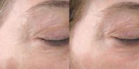 62 year old woman treated with hyperpigmentation