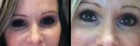 Dr Theda C. Kontis, MD, Baltimore Board Certified Facial Plastic Surgeon Asian Blepharoplasty Picture