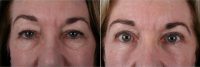 Dr Theda C. Kontis, MD, Baltimore Facial Plastic Surgeon - 55 Year Old Woman Treated With Eyelid Surgery