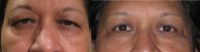 Hispanic female treated with upper eyelid surgery
