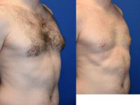 25-34 year old man treated with Male Breast Reduction