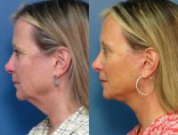 Upper Eyelid Surgery, Facelift & Brow Lift