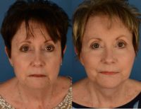 71 year old woman treated with Facelift