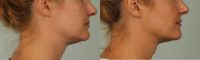 32 year old woman treated with Kybella