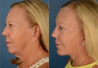 55-64 year old woman treated with Chin Implant, Uplift Lower Face and Neck Lift