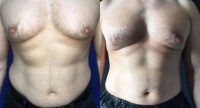 35-44 year old man treated with CoolSculpting
