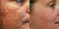 Woman treated with Acne Scars Treatment