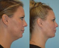 35-44 year old woman treated with ThermiSmooth Face