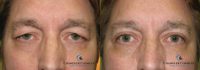 55-64 year old man treated with Eyelid Surgery (Blepharoplasty)