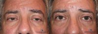 65-74 year old man treated with Ptosis Surgery