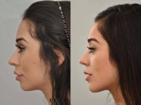 24 year old woman treated with Chin Surgery