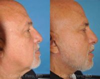Man treated with Facelift