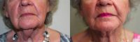 83 year old woman treated with Smart Lipo