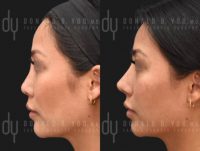 Asian Rhinoplasty with Rib cartilage and DCF