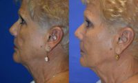 65-74 year old woman treated with Bellafill