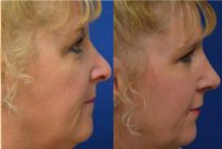 45-54 year old woman treated with Revision Rhinoplasty