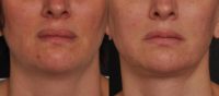 45-54 year old woman treated with Injectable Fillers