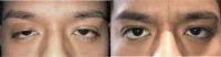 25-34 year old man treated with Ptosis Surgery