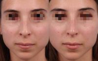 Woman treated with Nonsurgical Nose Job