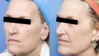 55-64 year old woman treated with Laser Resurfacing