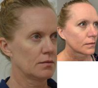 45-54 year old woman treated with MACS Facelift