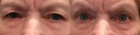 65-74 year old woman treated with Ptosis Surgery