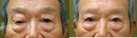 65-74 year old man treated with revision of prior Asian Eyelid Surgery