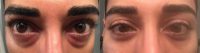 25-34 year old man treated with Eye Bags Treatment
