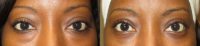 35-44 year old woman treated with Eye Bags Treatment