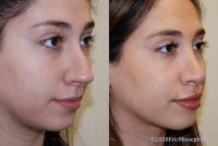 23 year old woman treated with Rhinoplasty - 1 year after surgery
