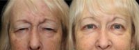 65-74 year old woman treated with Eyelid Surgery