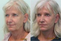65-74 year old woman treated with Facelift, Browlift, and Upper Blepharoplasty