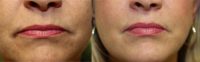 35-44 year old woman treated with Lip Augmentation