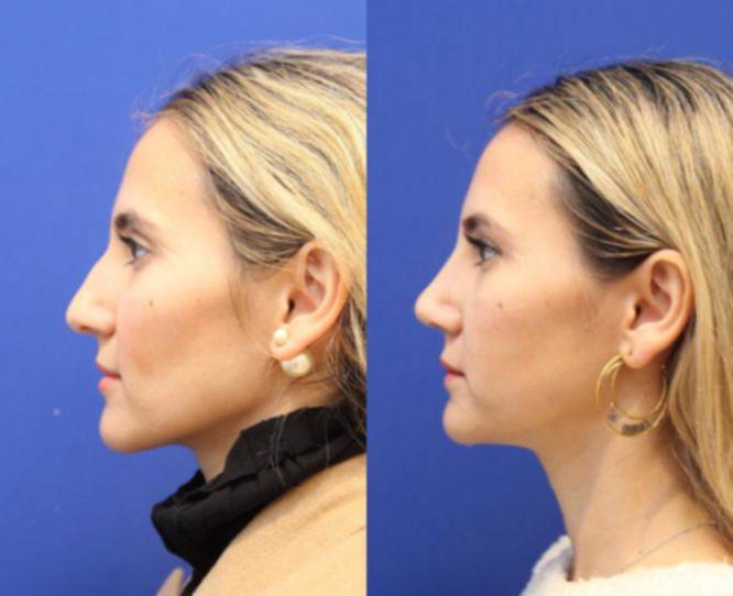 Rhinoplasty NYC Reviews, Cost, Risks & Candidacy