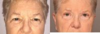 65-74 year old woman treated with Ptosis Surgery