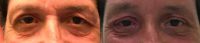 45-54 year old man treated with Brow Lift