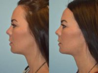 35-44 year old woman treated with Juvederm in the Jaw Line