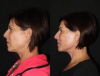 45-54 year old woman treated with Facelift, Revision Neck Lift, CO2 Laser, PRP