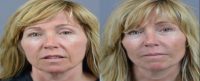 45-54 year old woman treated with Voluma