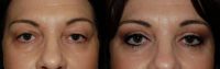 45 year old female who wanted upper eyelid surgery